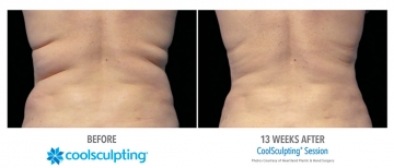 CoolSculpting before and after results at OC Weight Loss and Med Spa
