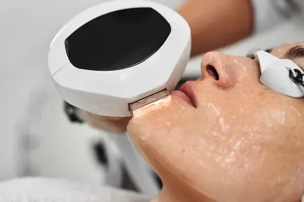 IPL laser treatments for sun damage