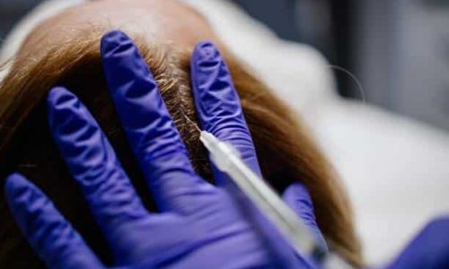Platelet rich plasma preparation