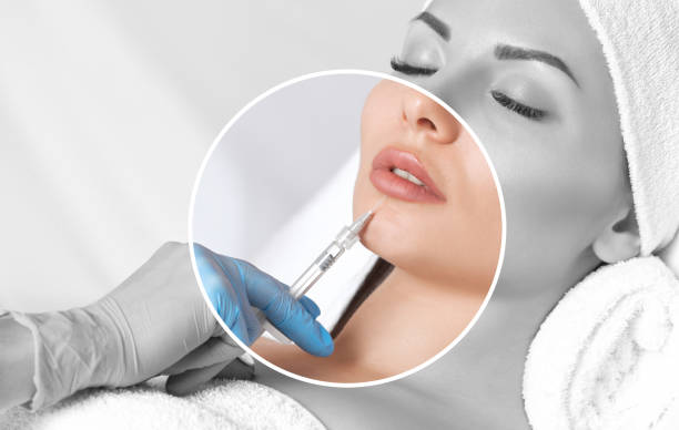 Juvederm dermal filler