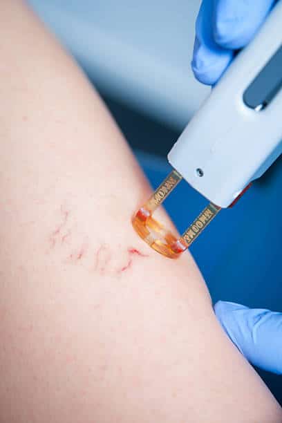 Laser vein removal for spider veins